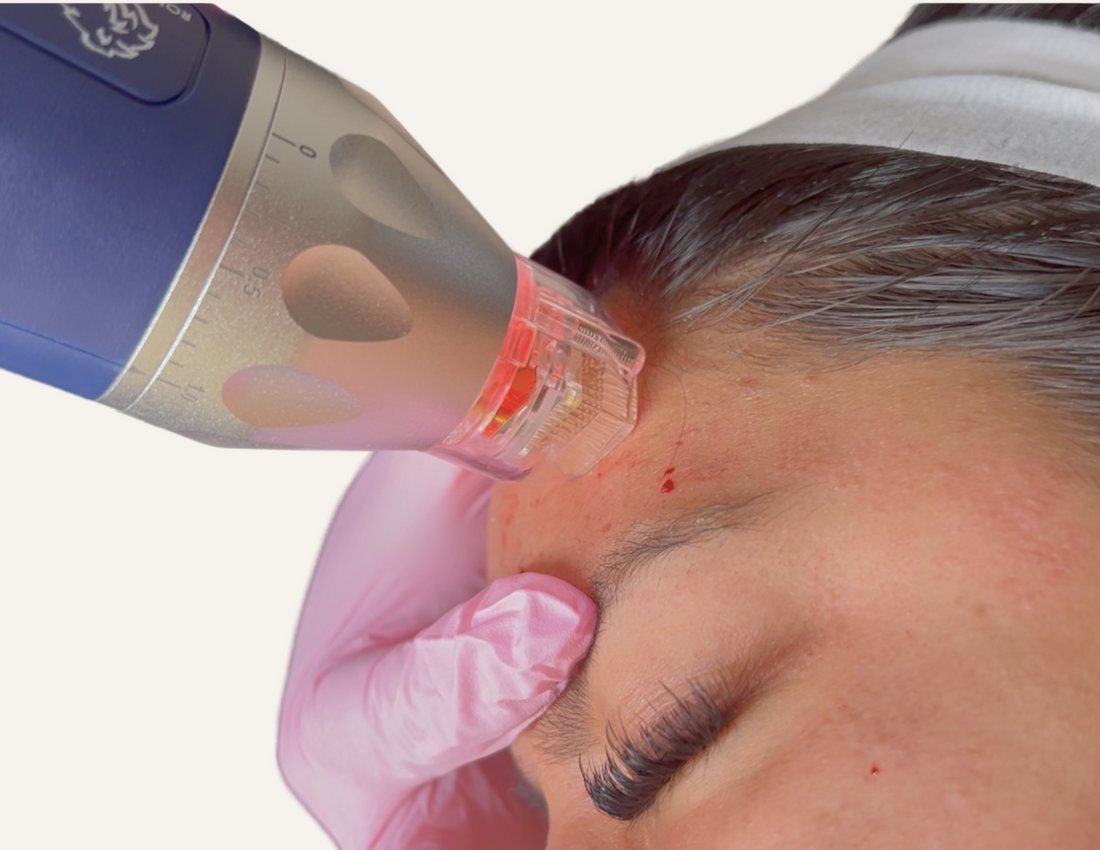 The Benefits of RF Microneedling: Why It’s the Ultimate Skin Renewal Treatment