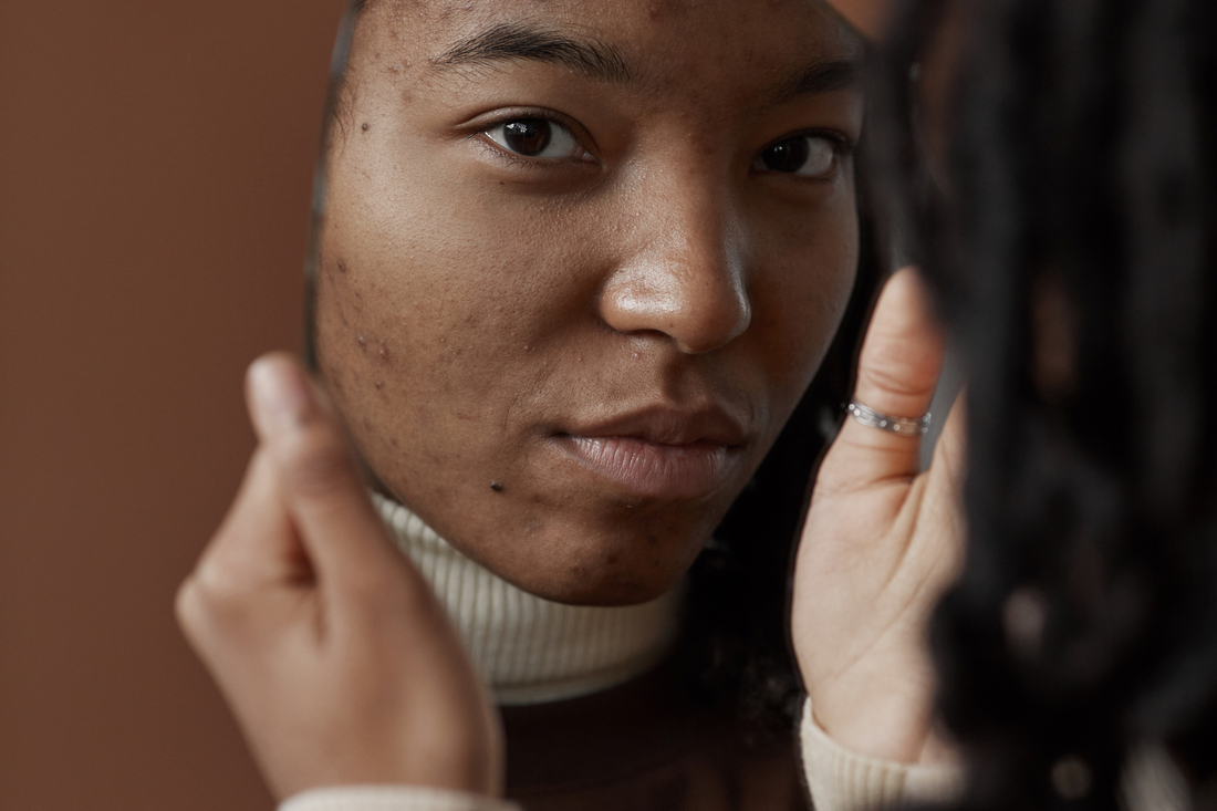 The Hidden Impact of Acne: How It Affects Mental Health