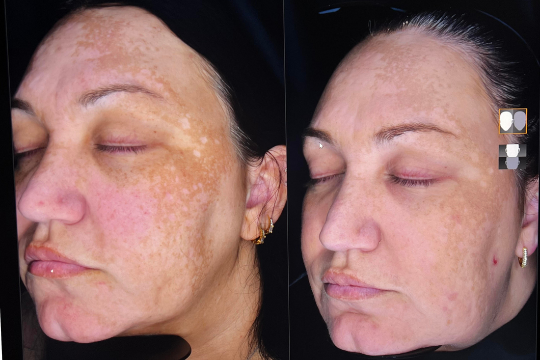 The Cosmelan Peel: Your Ultimate Solution for Hyperpigmentation & Melasma