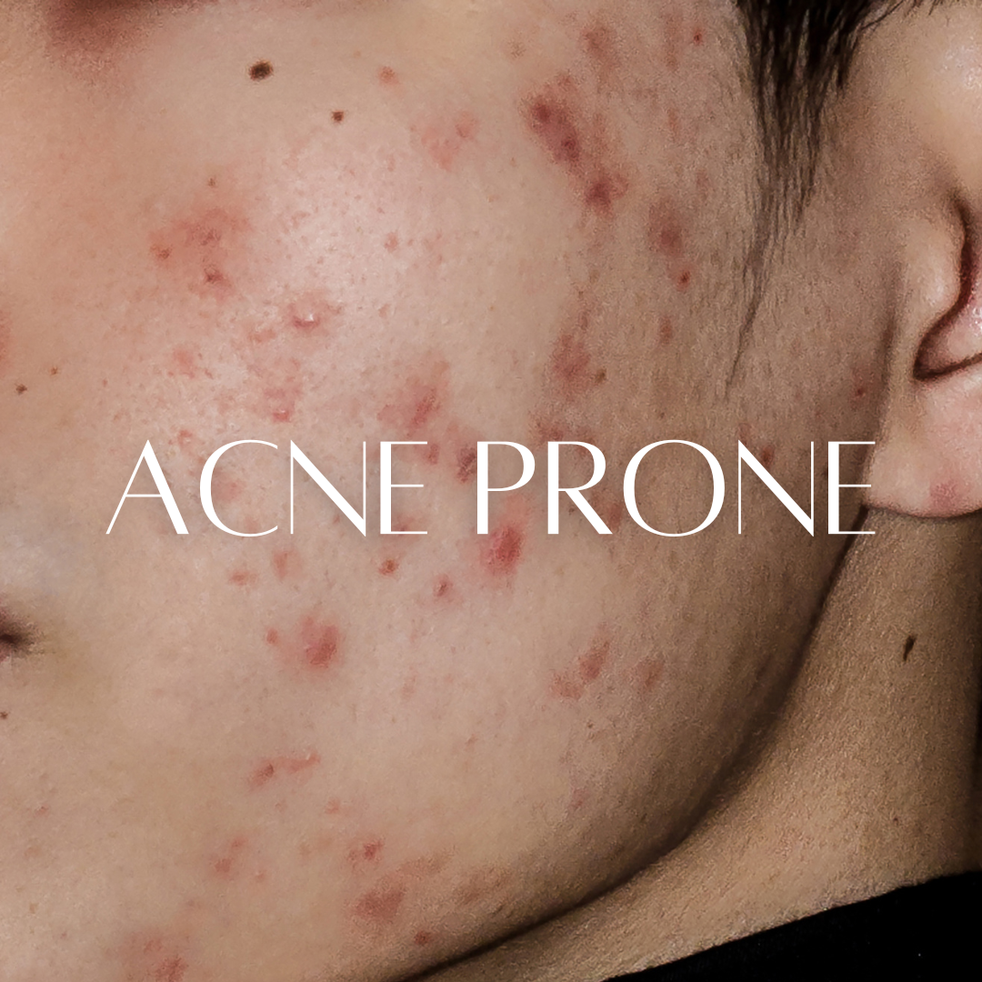 Acne Prone skin