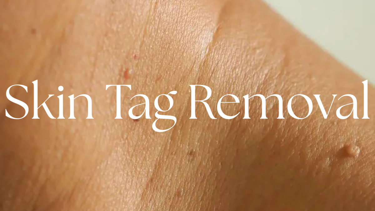 Skin Tag String Skin Tag Removal | Nalu Skin & Body DFW Arlington, TX